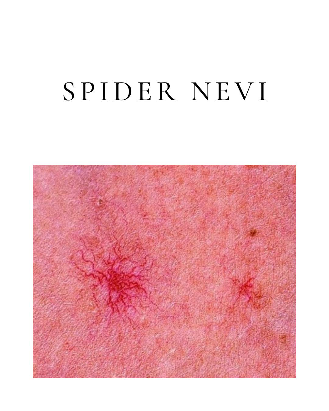 Spider Naevi